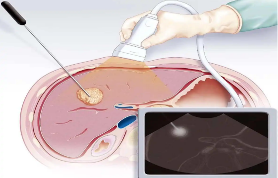  针尖上的“技术”---超声介入